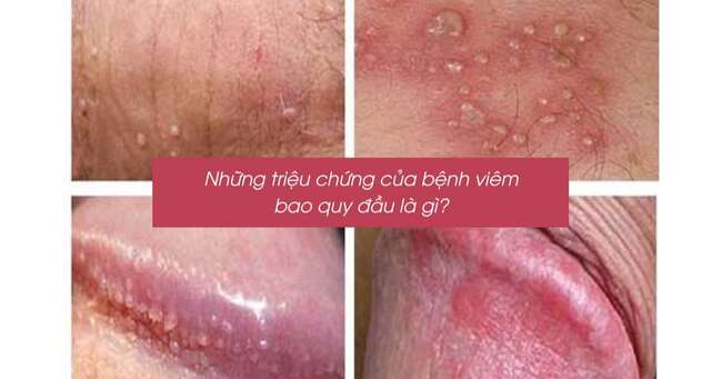 Nhận biết dấu hiệu viêm quy đầu ở nam giới bằng cách nào?