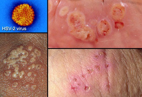 herpes sinh dục là bệnh lây truyền qua đường tình dục phổ biến và vô cùng nguy hiểm