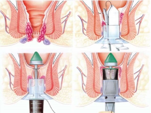 phương pháp điều trị bệnh trĩ PPH