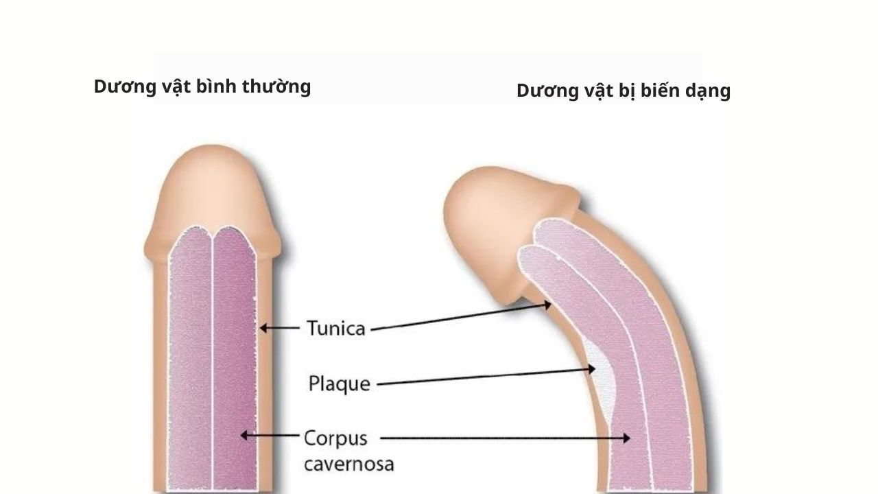 dài bao quy đầu làm dị dạng dương vật