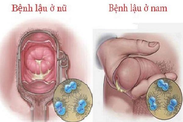 quan hệ tình dục không an toàn là nguyên nhân gây bệnh lậu ở nam giới