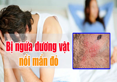 Bị ngứa dương vật liên tục là dấu hiệu cảnh báo bệnh gì?