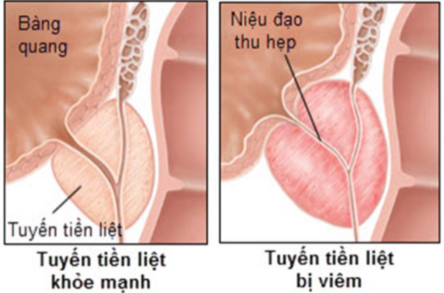 hình ảnh viêm tuyến tiền liệt (phải)