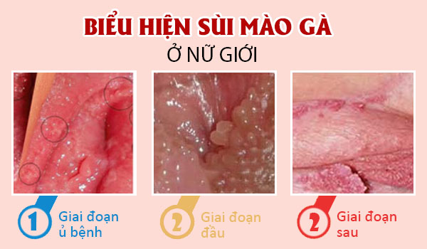 Sùi mào gà ở nữ: Nguyên nhân gây bệnh và phương pháp điều trị