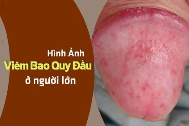 sự tấn công của vi khuẩn, nấm dẫn đến viêm sưng bao quy đầu