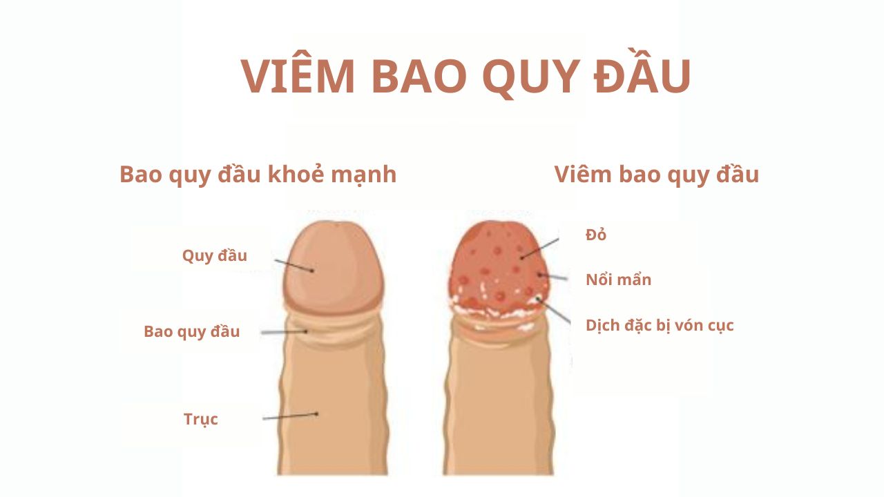 Viêm bao quy đầu: Nguyên nhân và dấu hiệu nhận biết