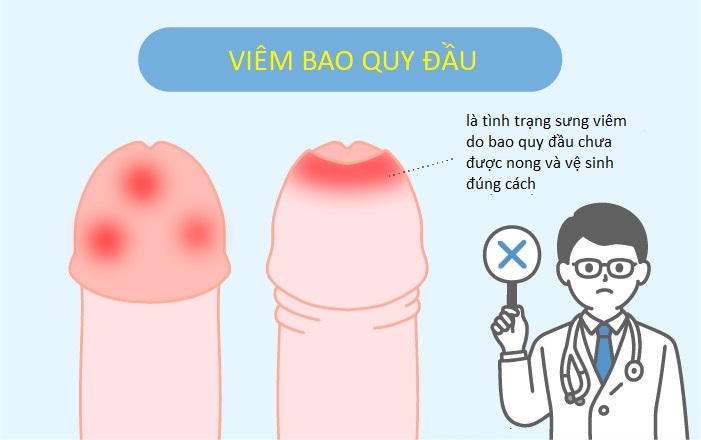 dấu hiệu viêm quy đầu ở nam giới