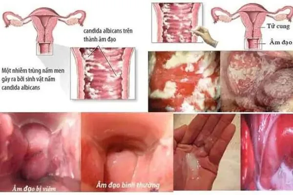 nấm Candida - nguyên nhân phổ biến gây viêm ngứa vùng kín nấm Candida - nguyên nhân phổ biến gây viêm ngứa vùng kín