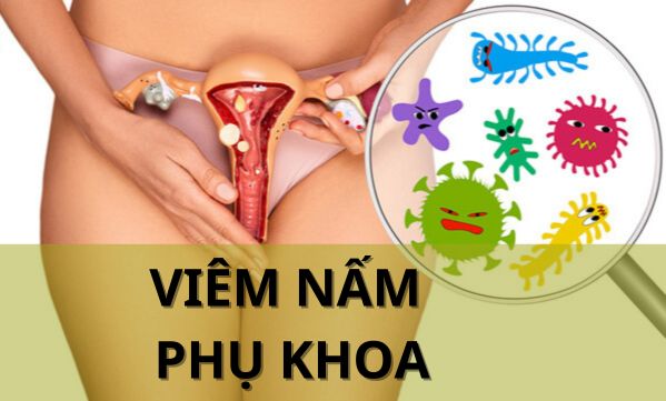 Viêm nấm phụ khoa: Những lưu ý mà chị em nên bỏ túi