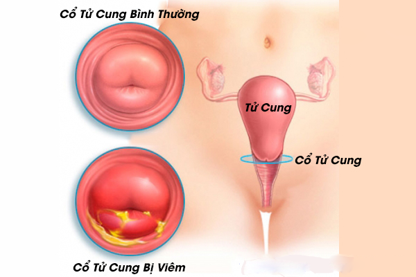 Viêm cổ tử cung có những dấu hiệu nhận biết nào?