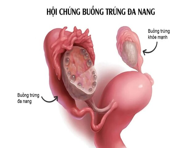 hội chứng buồng trứng đa nang (PCOS) có thể gây tắc kinh 3 tháng