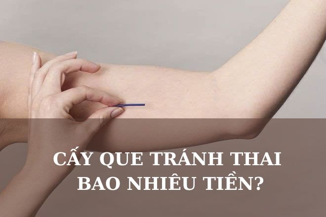 Tìm hiểu chi phí cấy que tránh thai: Bao nhiêu là hợp lý?