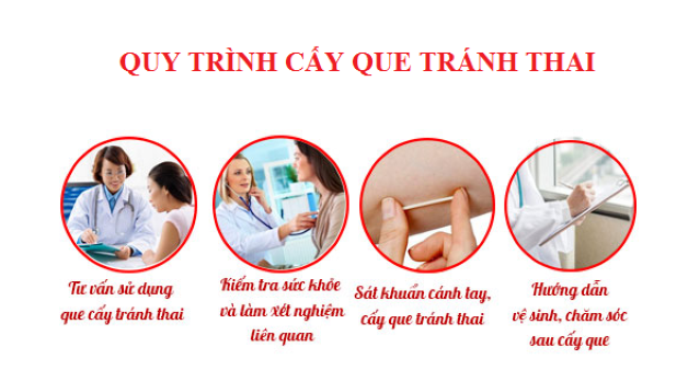 quy trình cấy que tránh thai nên được thực hiện cẩn thận