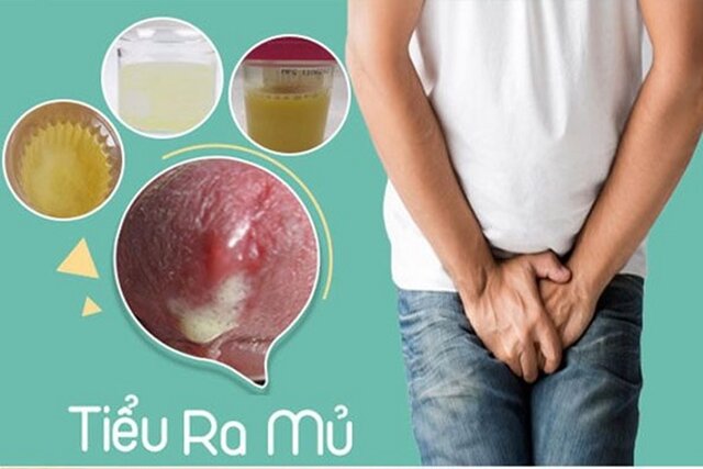 Tìm hiểu triệu chứng đi tiểu buốt ra mủ và những nguy cơ tiềm ẩn