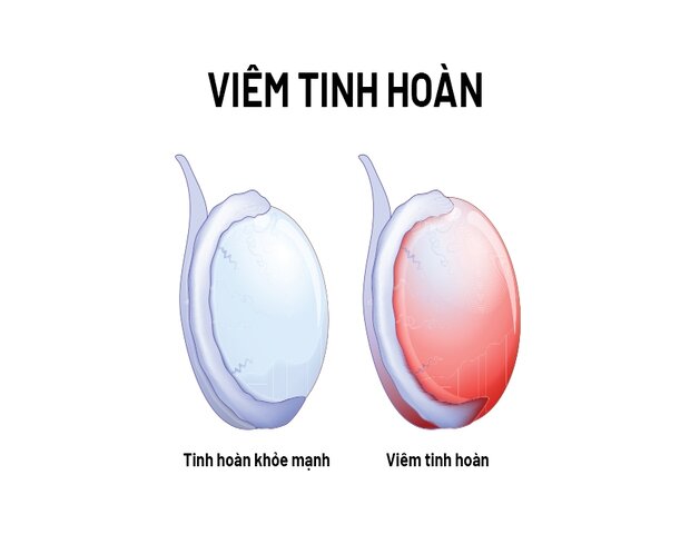 viem-tinh-hoan.jpg