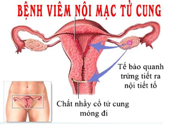 hình ảnh viêm nội mạc tử cung