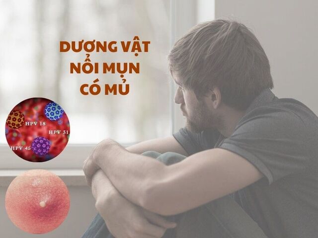 Cần làm gì khi phát hiện dương vật nổi mụn có mủ?