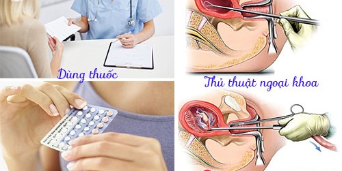 Phá thai an toàn là gì? Những thông tin quan trọng chị em nên biết