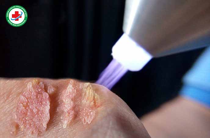 Áp dụng các phương pháp đốt sùi mào gà hiện đại