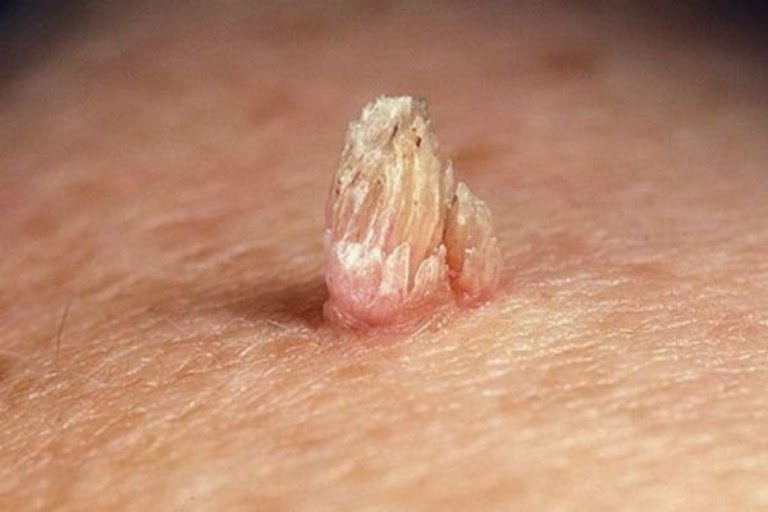 nốt sùi xuất hiện trên bộ phận sinh dục