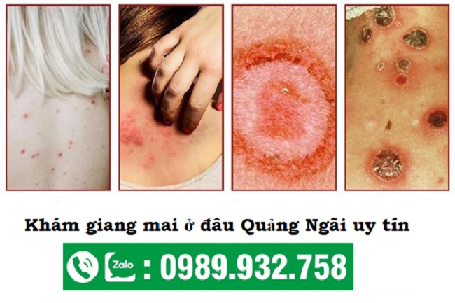 Khám bệnh giang mai ở đâu Quảng Ngãi an toàn, uy tín và kín đáo