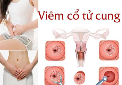 Khám viêm cổ tử cung ở đâu Quảng Ngãi uy tín, chi phí hợp lý