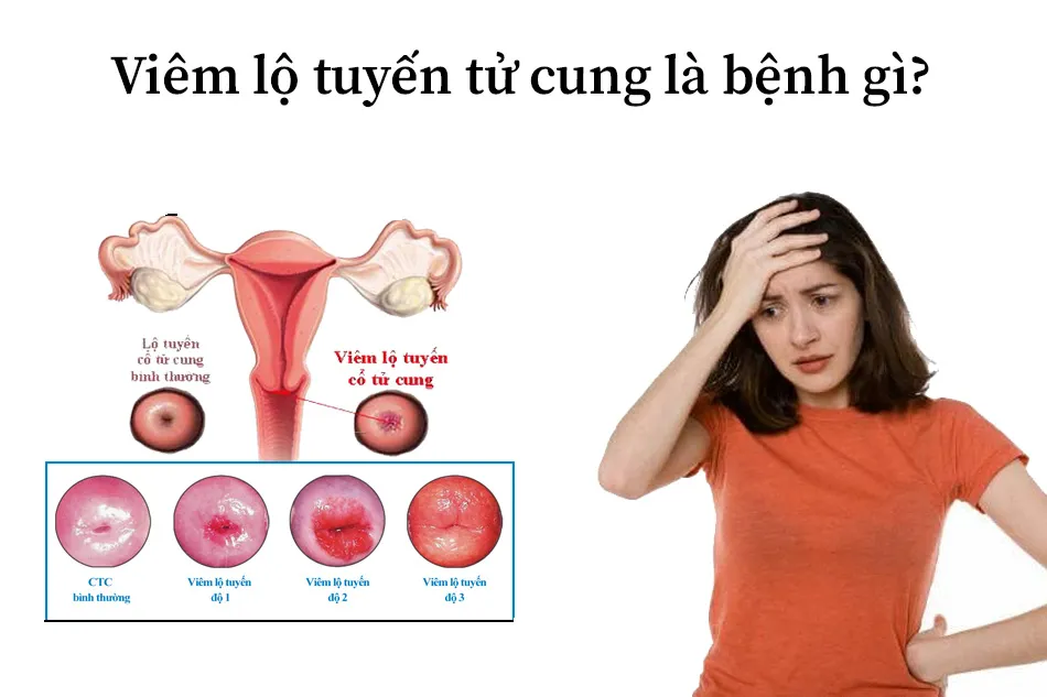Khám viêm lộ tuyến cổ tử cung ở đâu Quảng Ngãi tin cậy, chi phí nhỏ